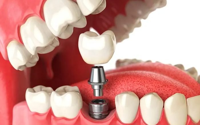 Modelo dental con implante colocado en la encía